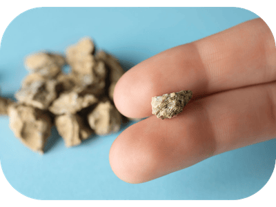 Kidney Stone Treatment